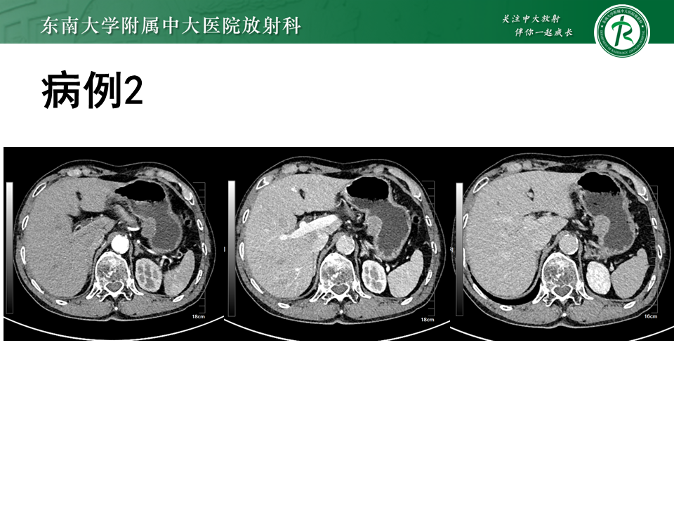 影像PPT - 【PPT】胃间质瘤（GST）-7