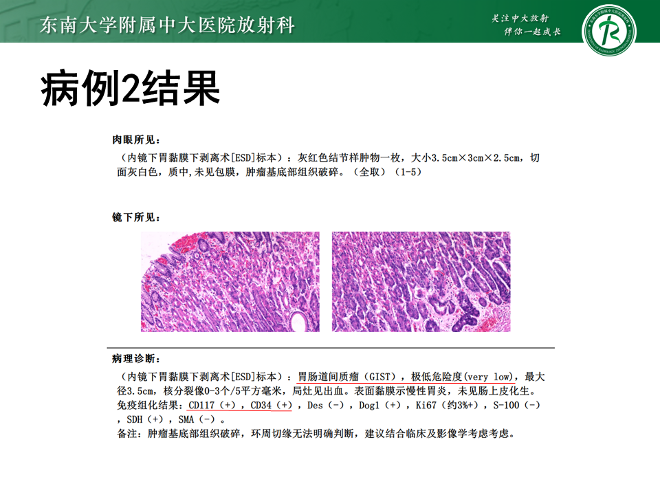 影像PPT - 【PPT】胃间质瘤（GST）-9