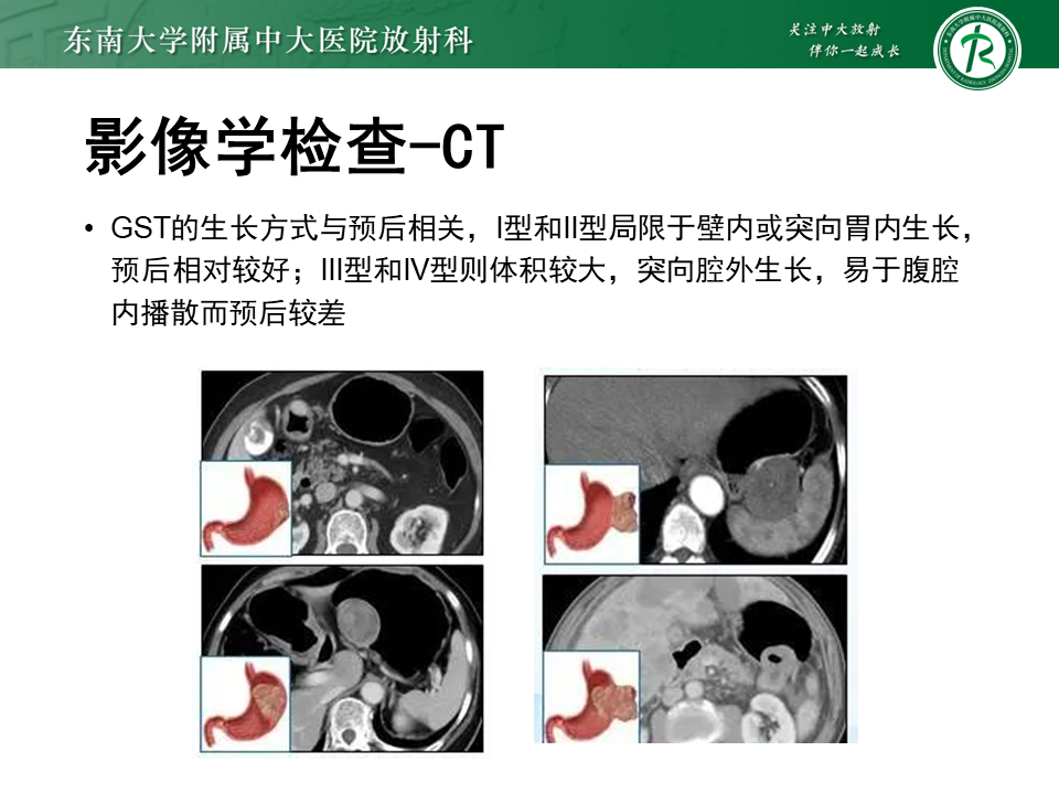 影像PPT - 【PPT】胃间质瘤（GST）-22