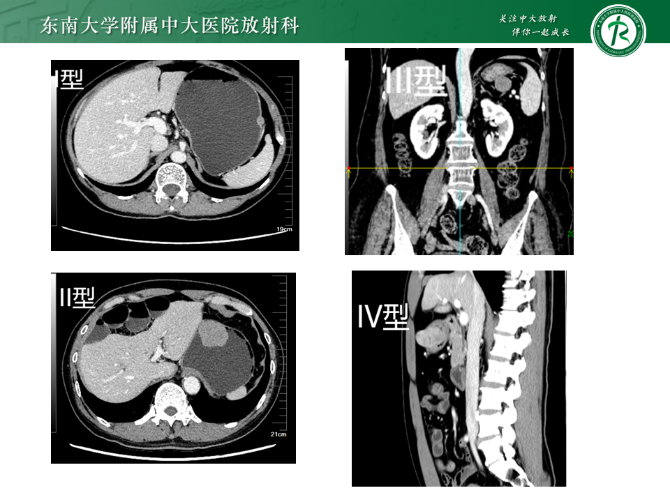 影像PPT - 【PPT】胃间质瘤（GST）-23