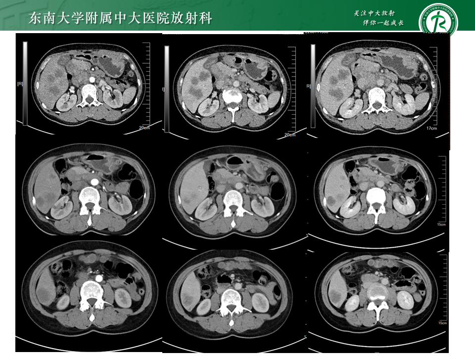 影像PPT - 【PPT】胃间质瘤（GST）-28