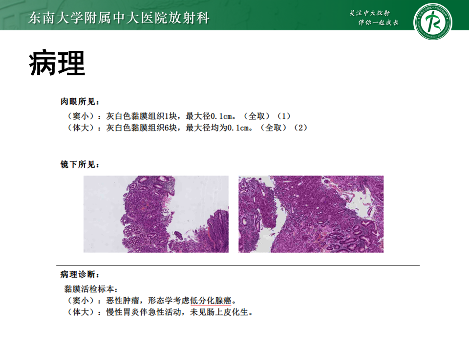 影像PPT - 【PPT】胃间质瘤（GST）-29
