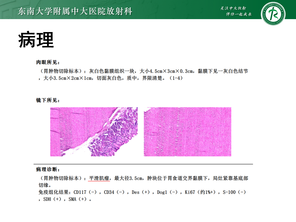 影像PPT - 【PPT】胃间质瘤（GST）-32