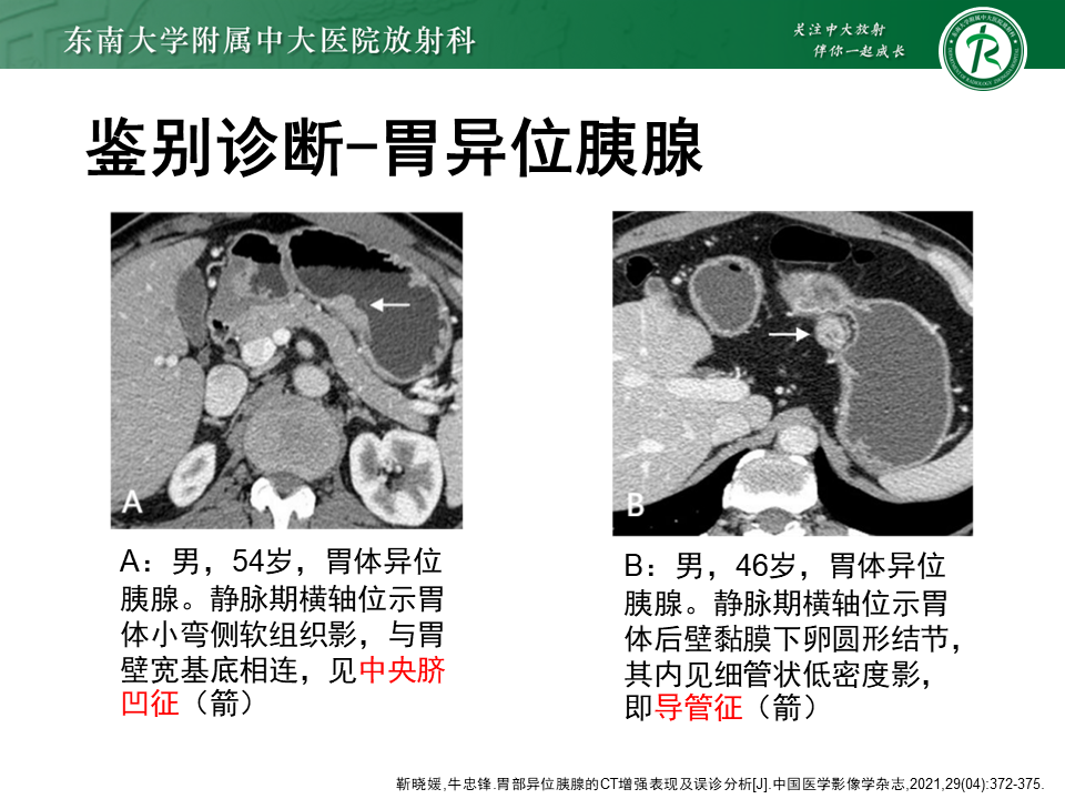 影像PPT - 【PPT】胃间质瘤（GST）-36