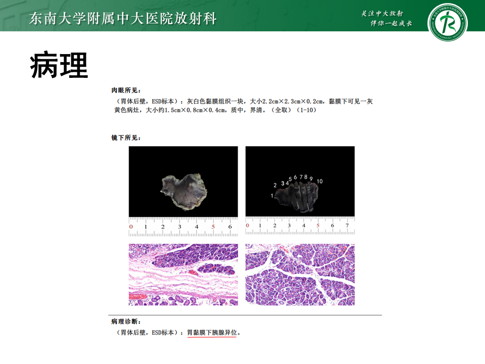 影像PPT - 【PPT】胃间质瘤（GST）-38