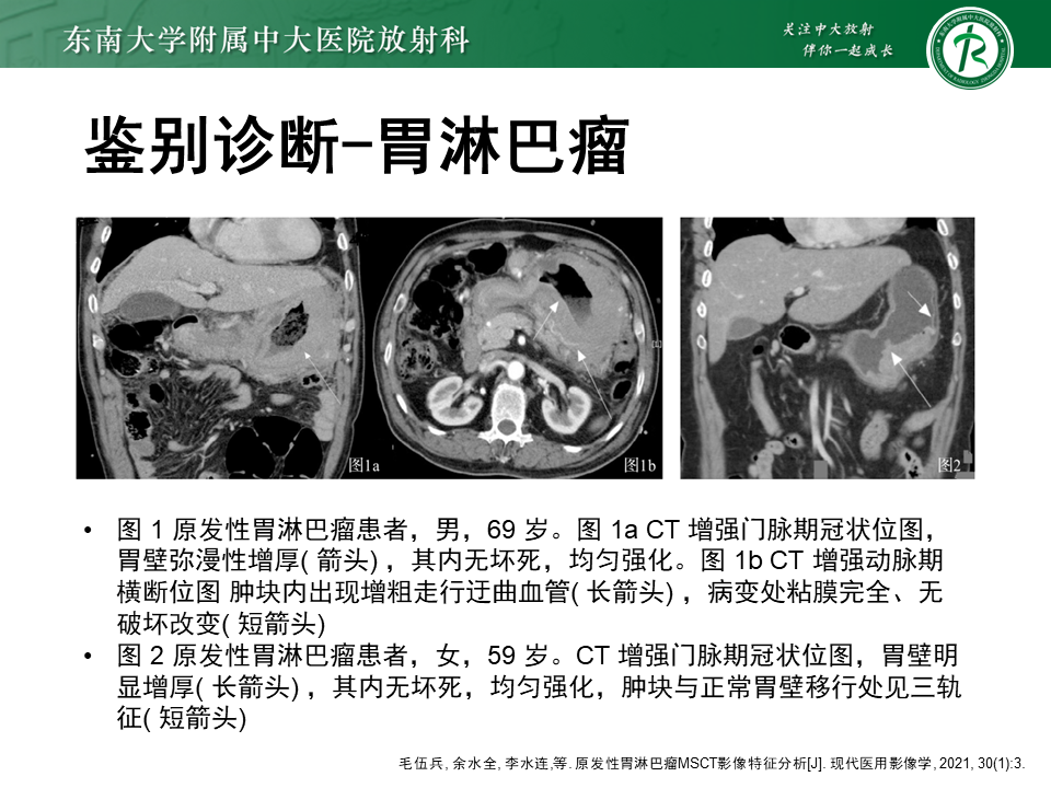 影像PPT - 【PPT】胃间质瘤（GST）-41