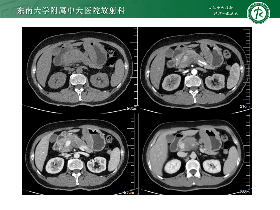 影像PPT - 【PPT】胃间质瘤（GST）-42