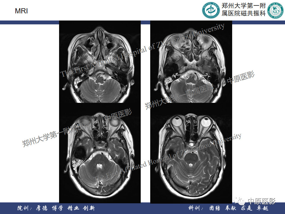 影像PPT - 【病例】颞部腱鞘巨细胞瘤1例CT及MR影像-4