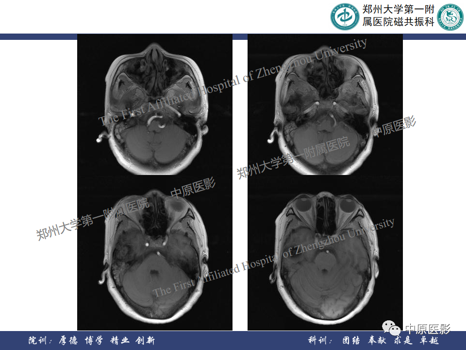 影像PPT - 【病例】颞部腱鞘巨细胞瘤1例CT及MR影像-5