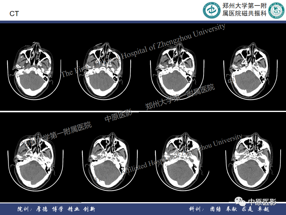 影像PPT - 【病例】颞部腱鞘巨细胞瘤1例CT及MR影像-3