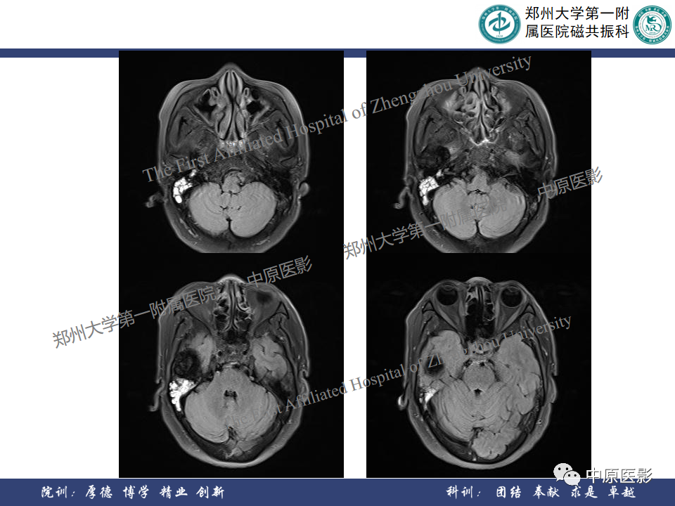 影像PPT - 【病例】颞部腱鞘巨细胞瘤1例CT及MR影像-6
