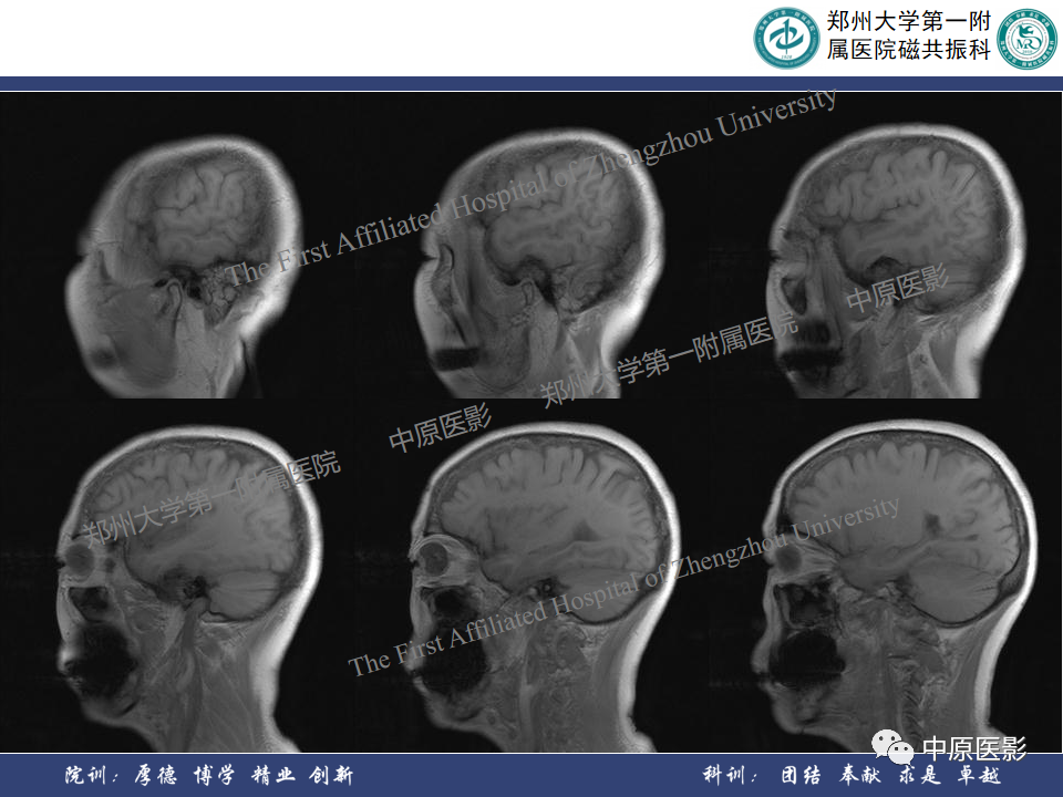 影像PPT - 【病例】颞部腱鞘巨细胞瘤1例CT及MR影像-7