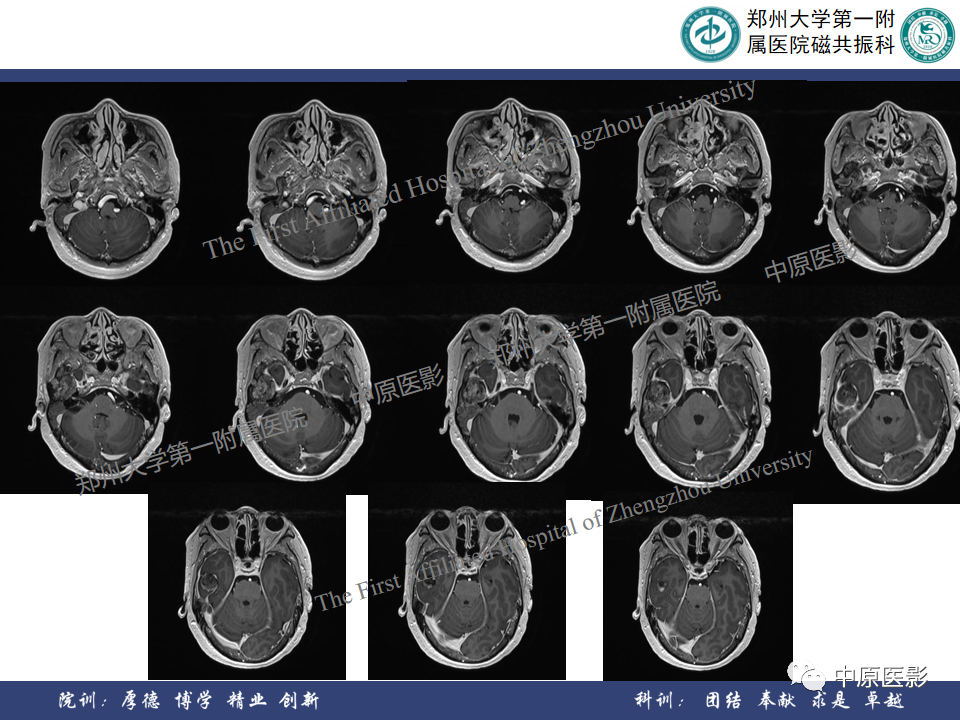 影像PPT - 【病例】颞部腱鞘巨细胞瘤1例CT及MR影像-9