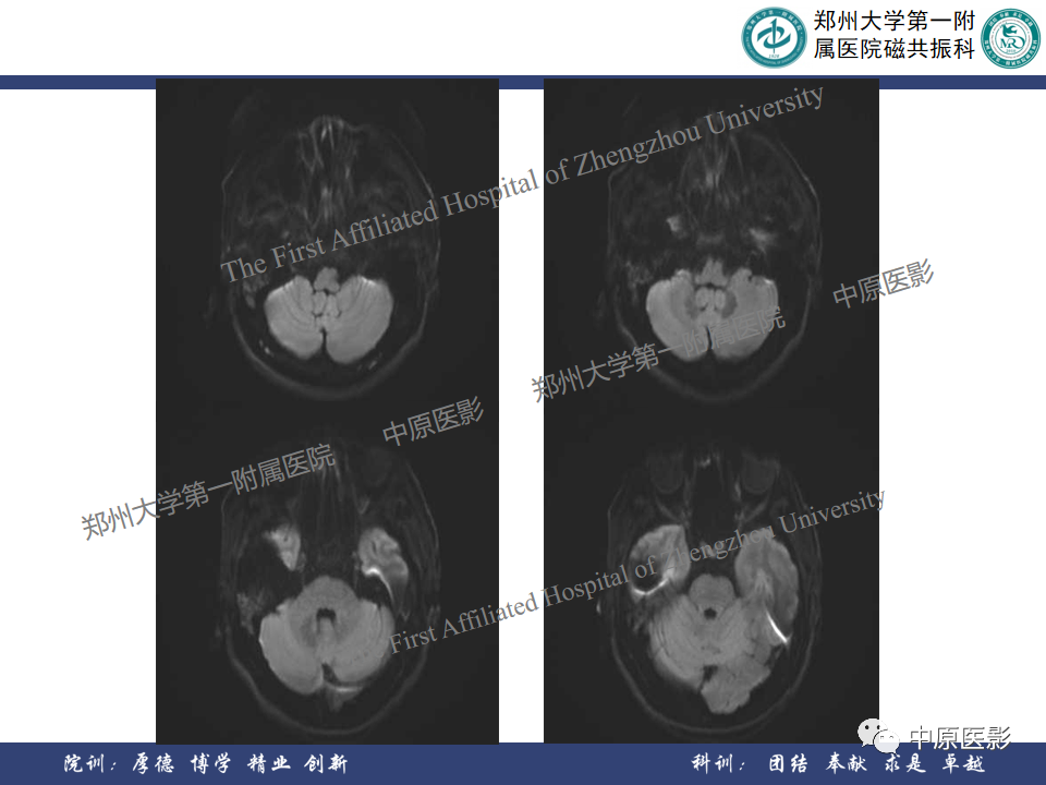 影像PPT - 【病例】颞部腱鞘巨细胞瘤1例CT及MR影像-8