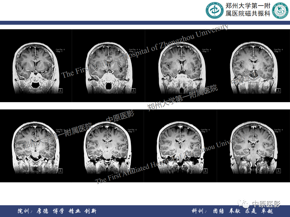 影像PPT - 【病例】颞部腱鞘巨细胞瘤1例CT及MR影像-10