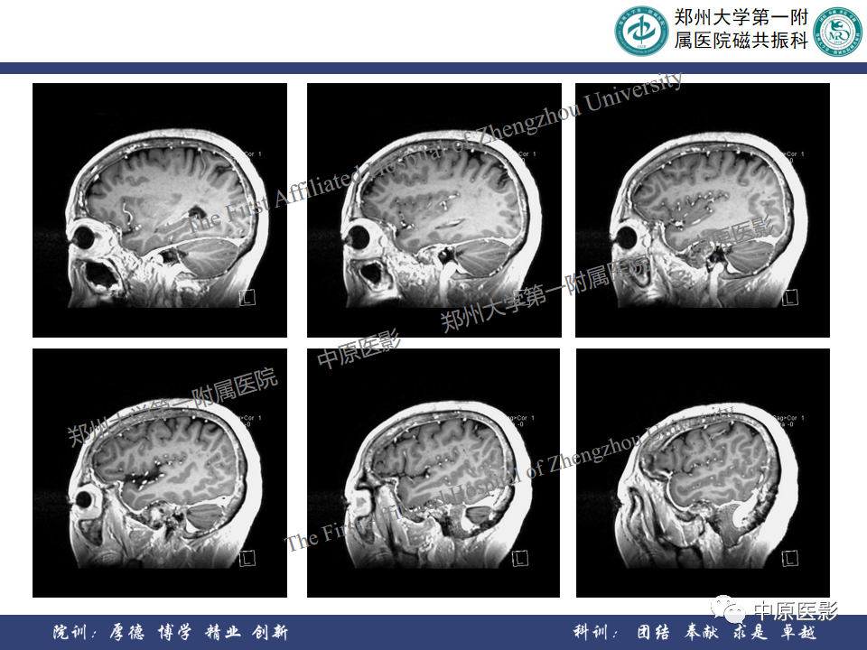 影像PPT - 【病例】颞部腱鞘巨细胞瘤1例CT及MR影像-11