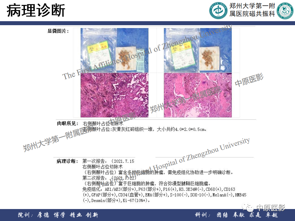 影像PPT - 【病例】颞部腱鞘巨细胞瘤1例CT及MR影像-14