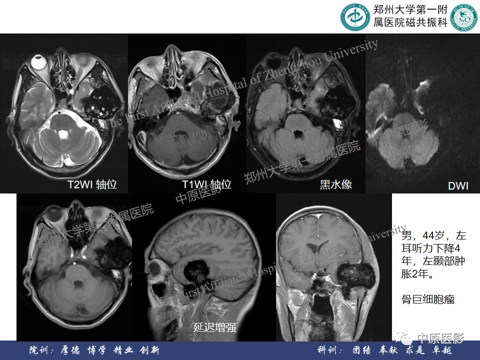 影像PPT - 【病例】颞部腱鞘巨细胞瘤1例CT及MR影像-20