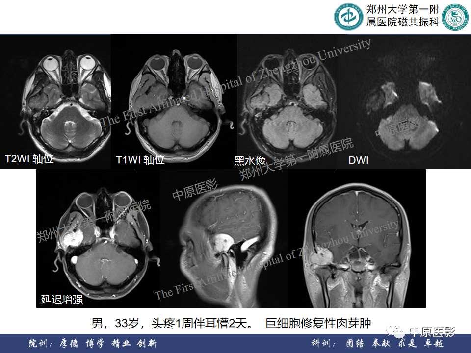 影像PPT - 【病例】颞部腱鞘巨细胞瘤1例CT及MR影像-23