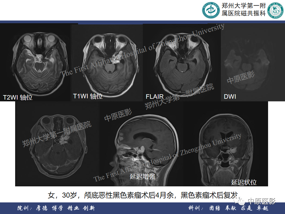 影像PPT - 【病例】颞部腱鞘巨细胞瘤1例CT及MR影像-26