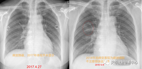 影像PPT - 不典型腺瘤样增生(AAH)-7 影像PPT - 不典型腺瘤样增生(AAH)-7