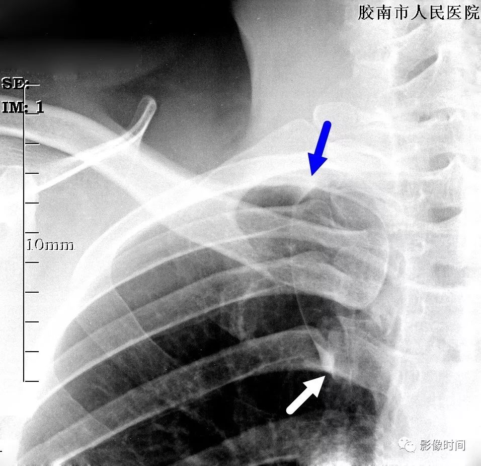 影像PPT - 肺部的“逗点征”-6 影像PPT - 肺部的“逗点征”-6