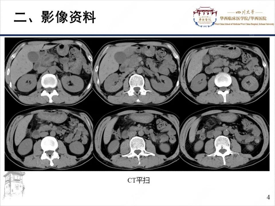 影像PPT - 【病例】胰腺癌1例CT影像-4