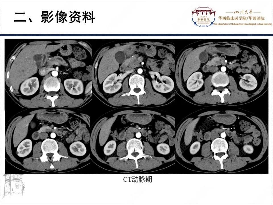 影像PPT - 【病例】胰腺癌1例CT影像-5