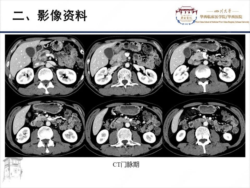 影像PPT - 【病例】胰腺癌1例CT影像-6