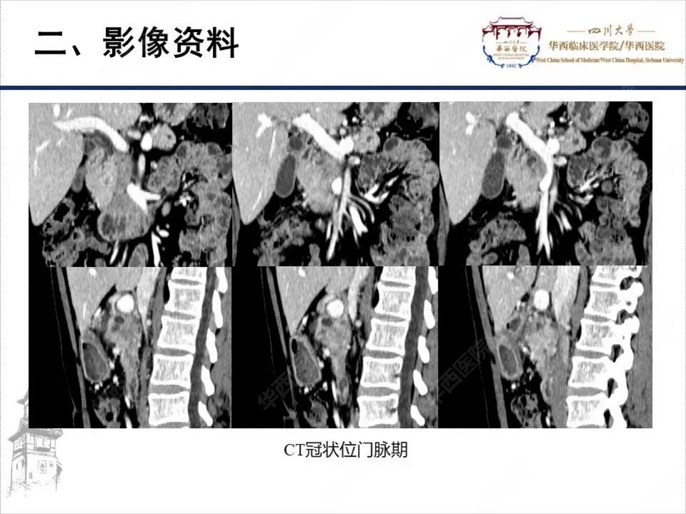 影像PPT - 【病例】胰腺癌1例CT影像-7