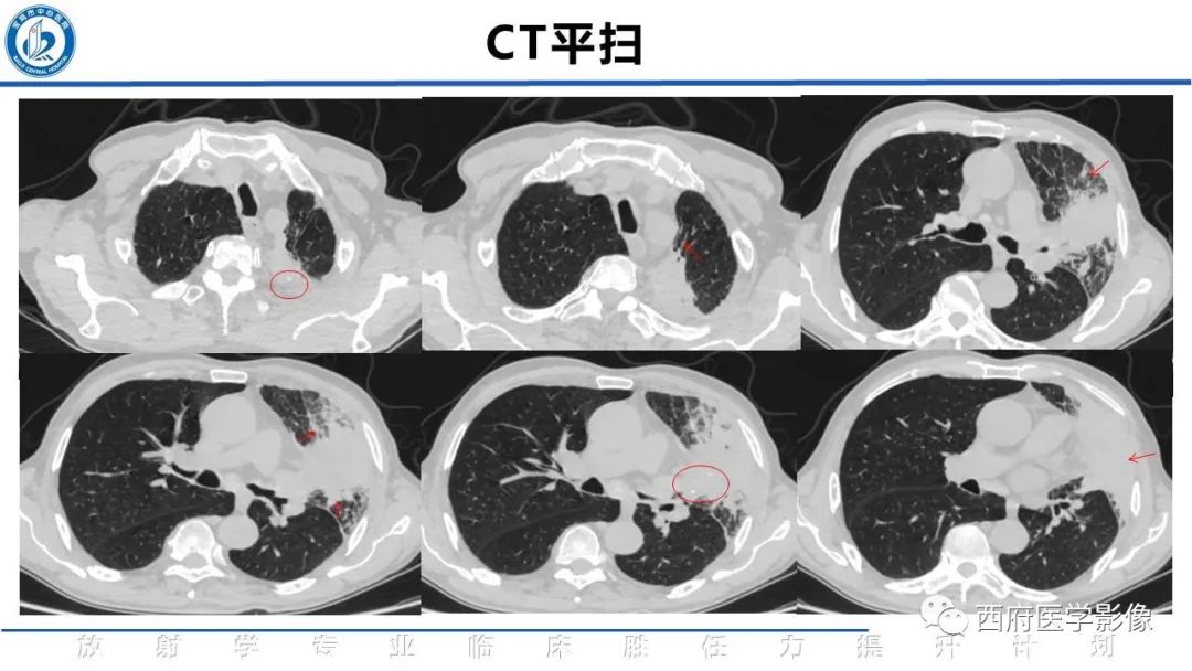 影像PPT - 【PPT】机化性肺炎影像学表现-4