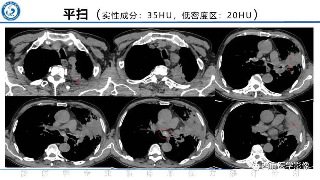影像PPT - 【PPT】机化性肺炎影像学表现-8