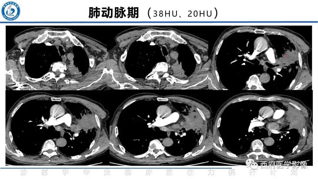 影像PPT - 【PPT】机化性肺炎影像学表现-9