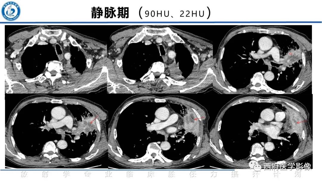 影像PPT - 【PPT】机化性肺炎影像学表现-11