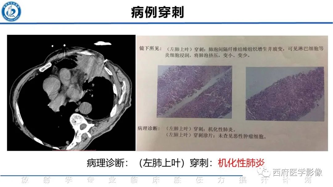影像PPT - 【PPT】机化性肺炎影像学表现-17