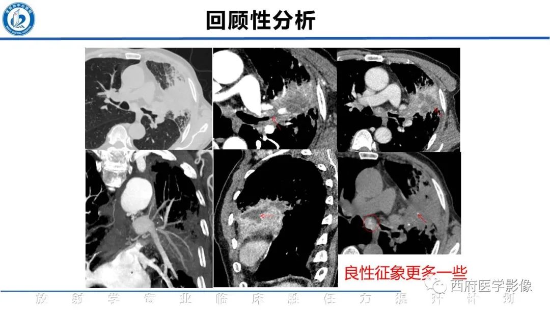 影像PPT - 【PPT】机化性肺炎影像学表现-18
