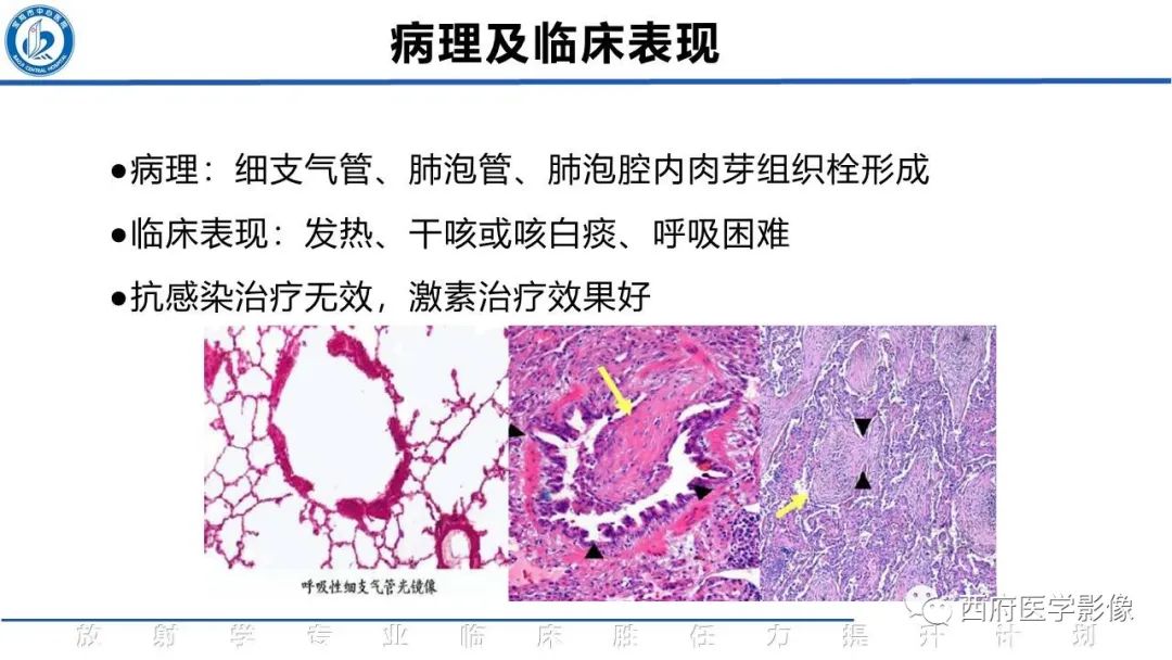 影像PPT - 【PPT】机化性肺炎影像学表现-23