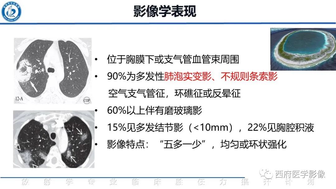 影像PPT - 【PPT】机化性肺炎影像学表现-24