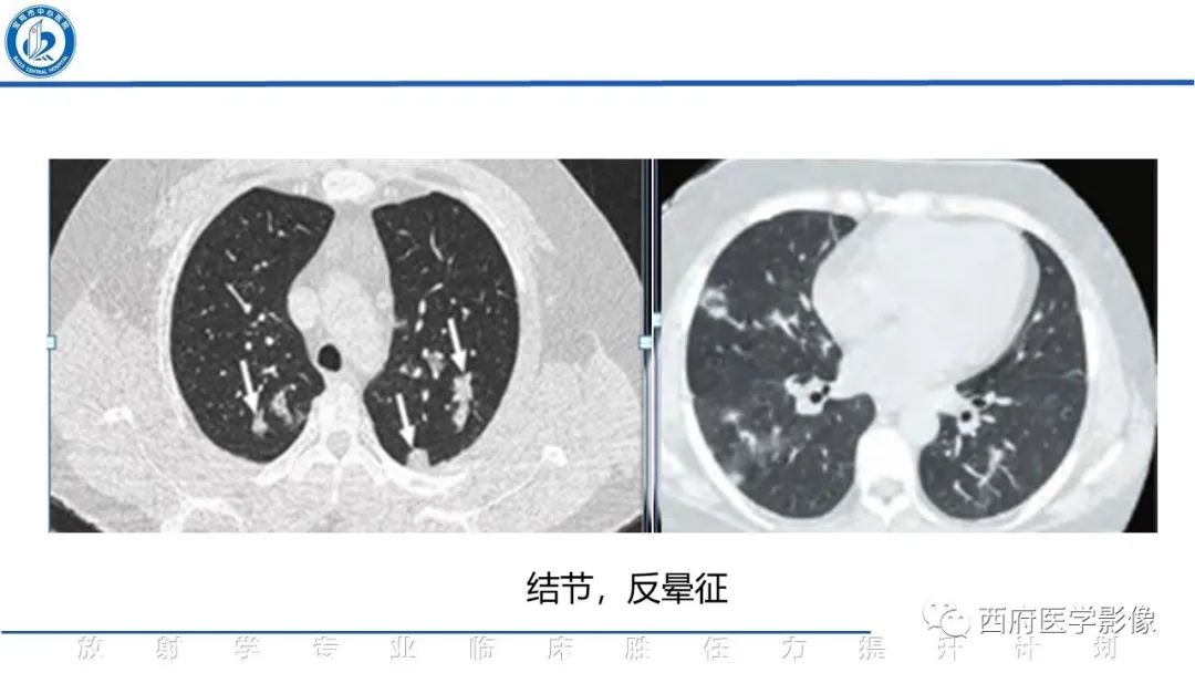影像PPT - 【PPT】机化性肺炎影像学表现-27