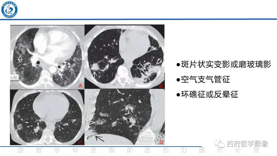 影像PPT - 【PPT】机化性肺炎影像学表现-26