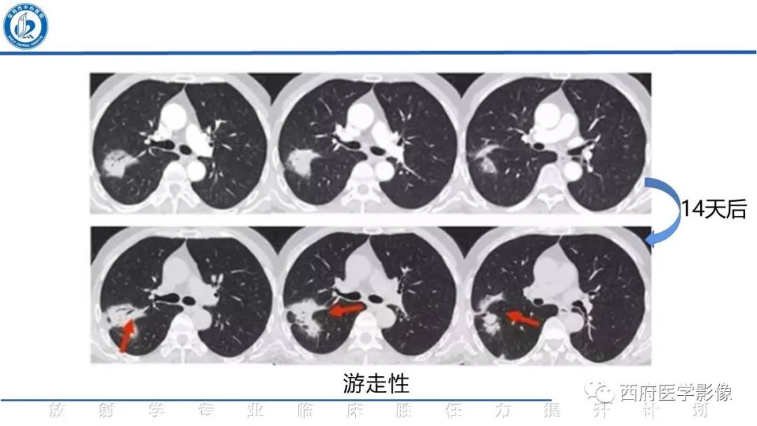 影像PPT - 【PPT】机化性肺炎影像学表现-28