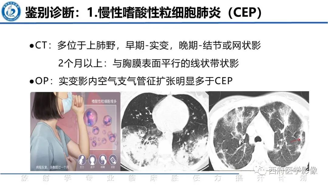 影像PPT - 【PPT】机化性肺炎影像学表现-31