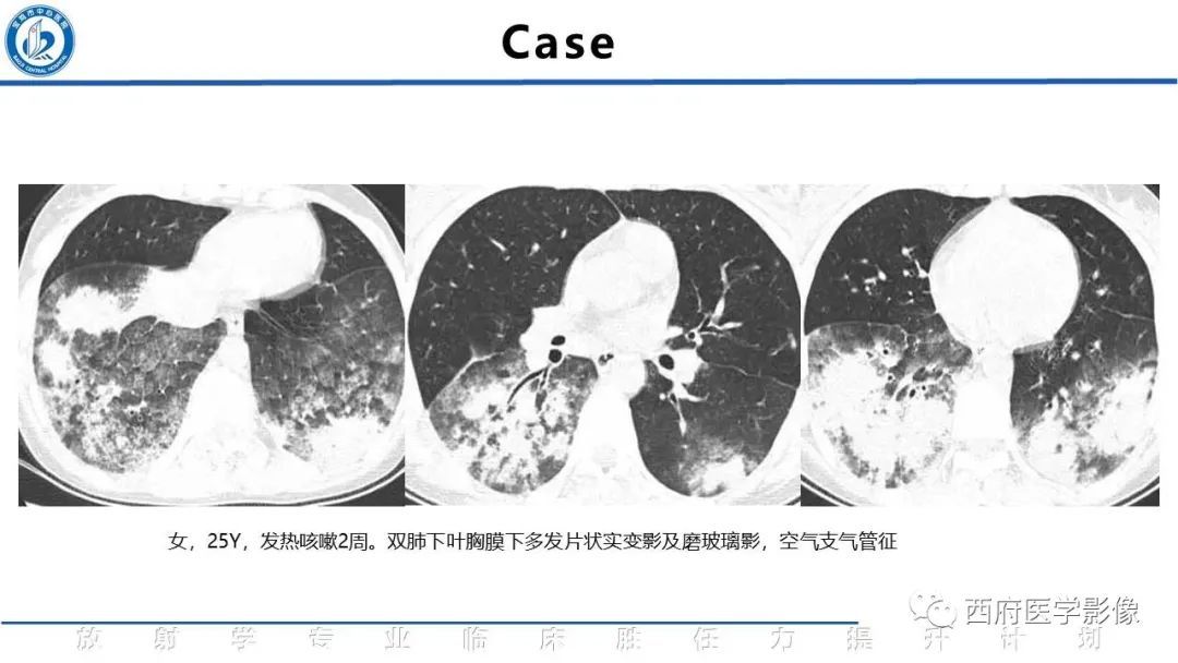 影像PPT - 【PPT】机化性肺炎影像学表现-32