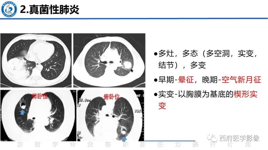 影像PPT - 【PPT】机化性肺炎影像学表现-33