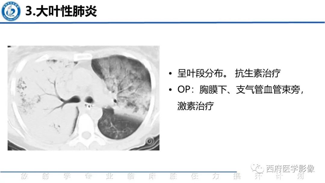 影像PPT - 【PPT】机化性肺炎影像学表现-34