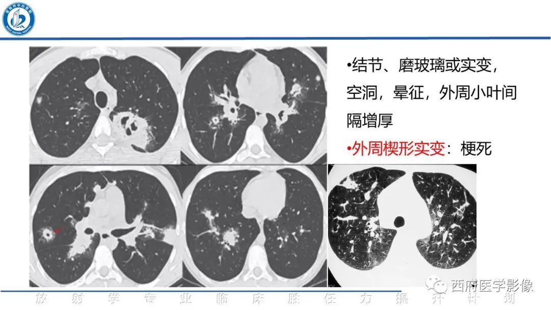 影像PPT - 【PPT】机化性肺炎影像学表现-36