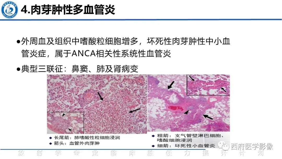 影像PPT - 【PPT】机化性肺炎影像学表现-35