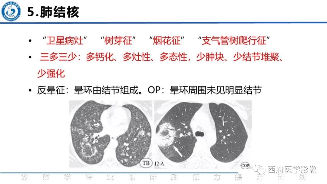 影像PPT - 【PPT】机化性肺炎影像学表现-37