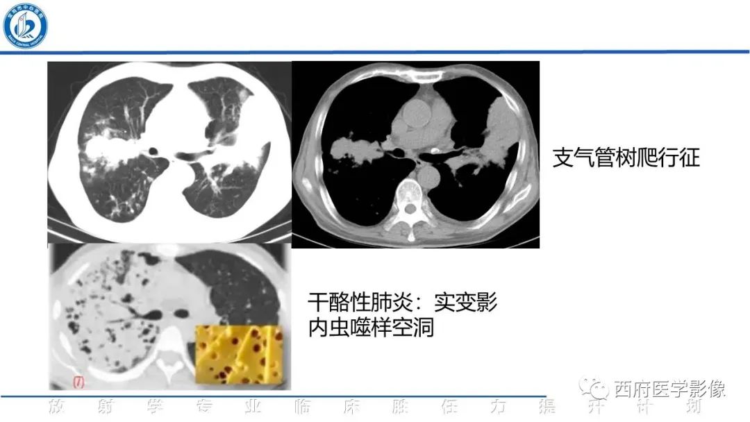 影像PPT - 【PPT】机化性肺炎影像学表现-38