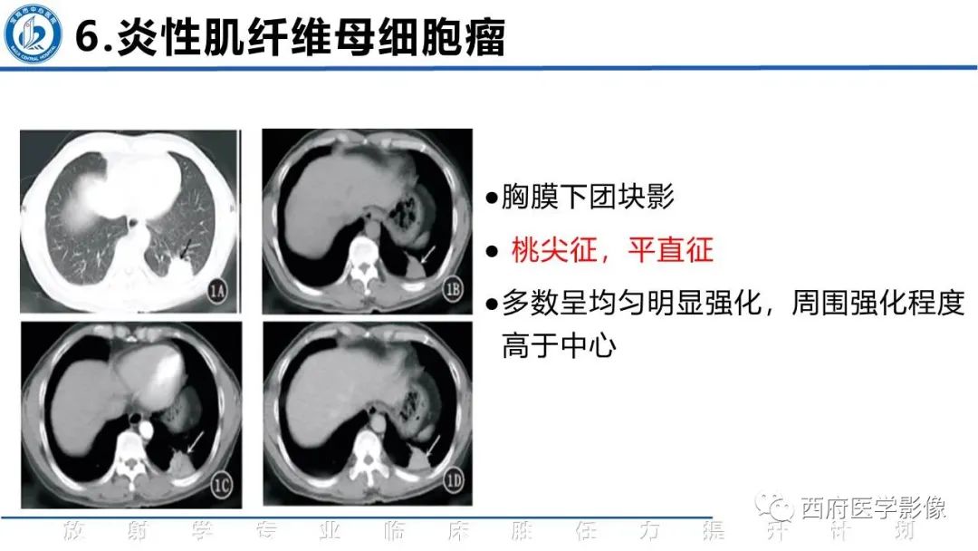 影像PPT - 【PPT】机化性肺炎影像学表现-39
